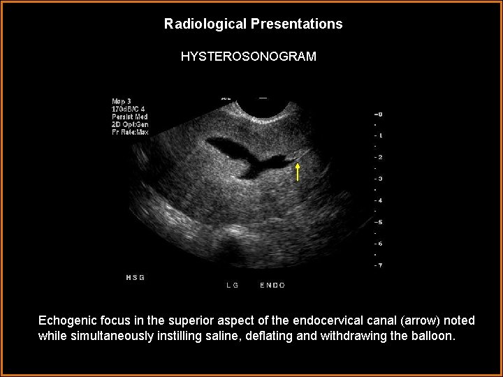 Radiological Presentations HYSTEROSONOGRAM Echogenic focus in the superior aspect of the endocervical canal (arrow)