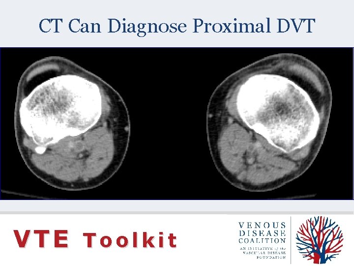 CT Can Diagnose Proximal DVT VTE Toolkit 