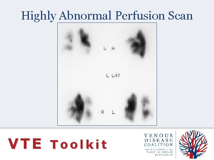 Highly Abnormal Perfusion Scan VTE Toolkit 