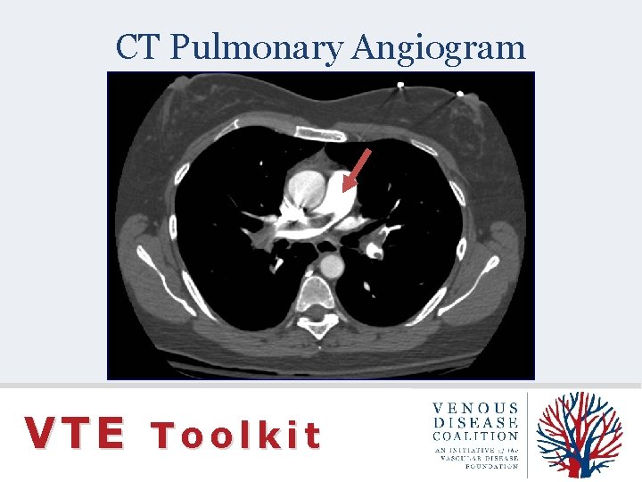 CT Pulmonary Angiogram VTE Toolkit 