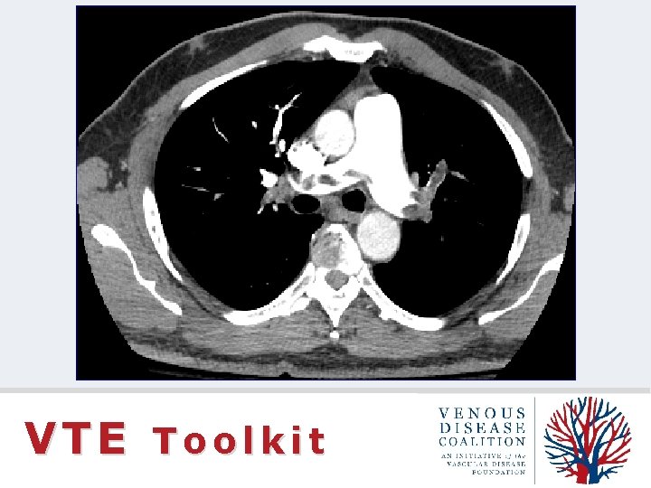 VTE Toolkit 