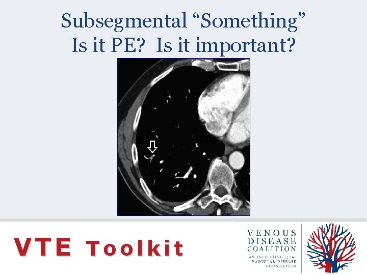 Subsegmental “Something” Is it PE? Is it important? VTE Toolkit 