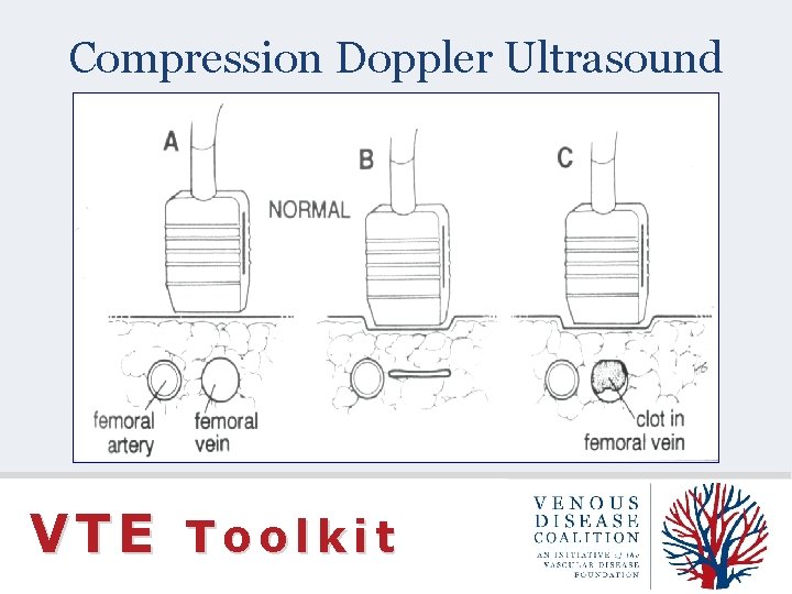 Compression Doppler Ultrasound VTE Toolkit 