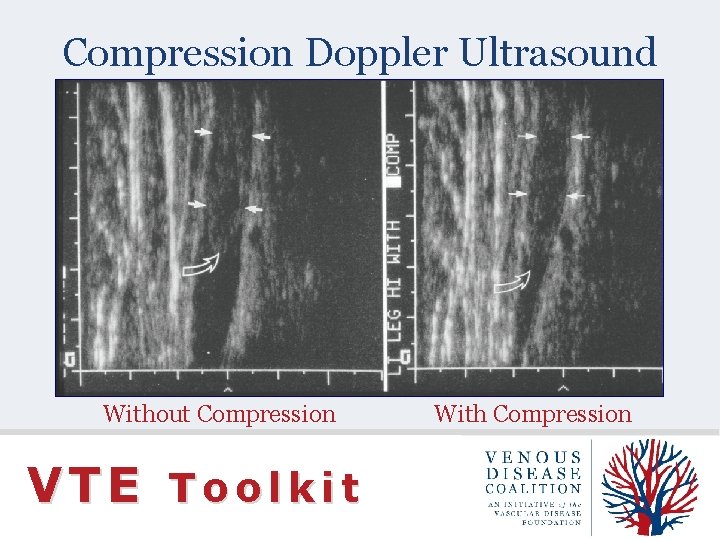 Compression Doppler Ultrasound Without Compression VTE Toolkit With Compression 