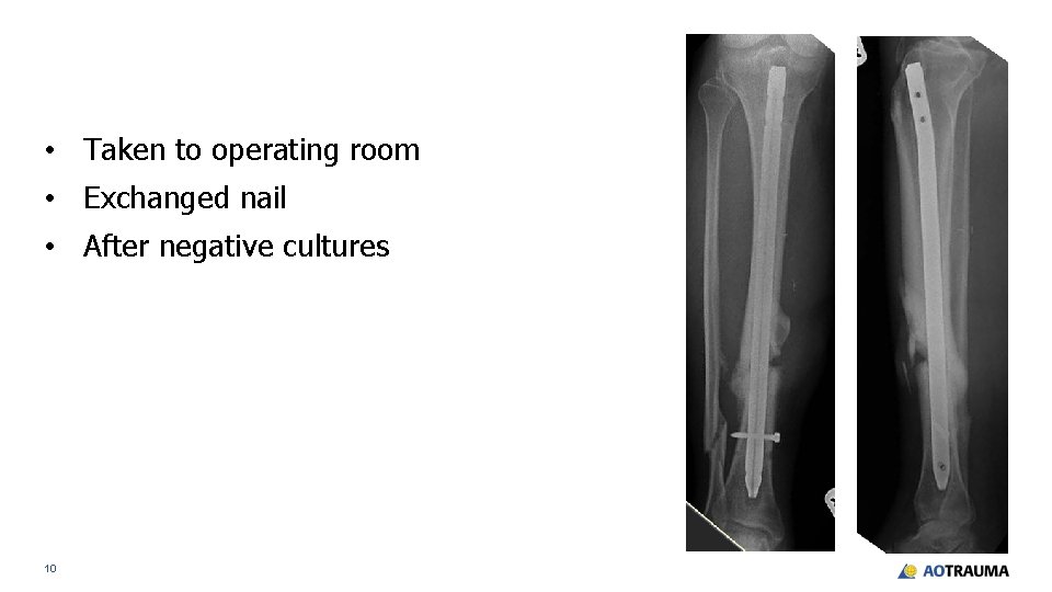  • Taken to operating room • Exchanged nail • After negative cultures 10