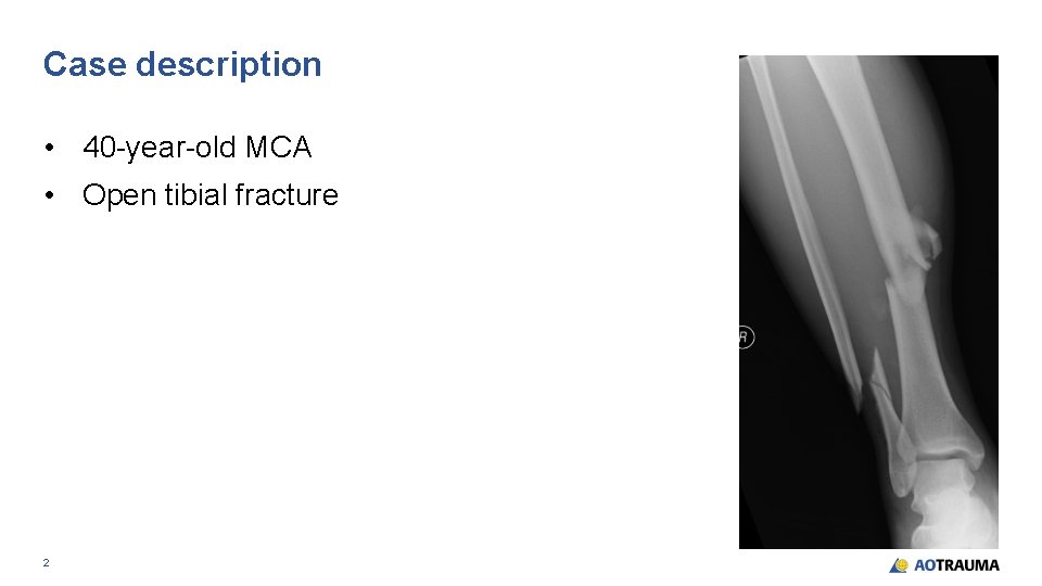 Case description • 40 -year-old MCA • Open tibial fracture 2 