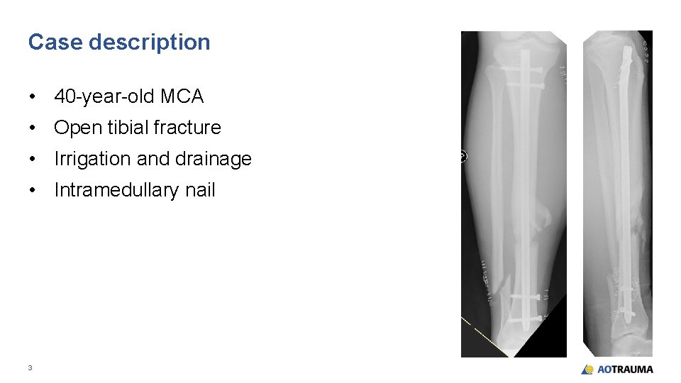 Case description • 40 -year-old MCA • Open tibial fracture • Irrigation and drainage