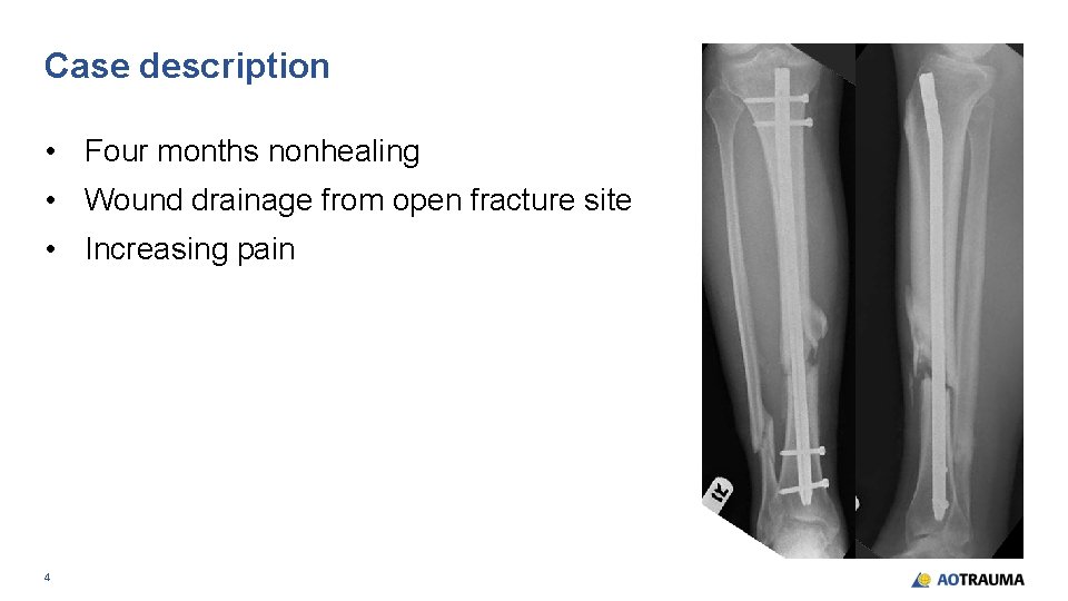 Case description • Four months nonhealing • Wound drainage from open fracture site •