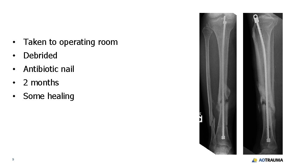  • Taken to operating room • Debrided • Antibiotic nail • 2 months