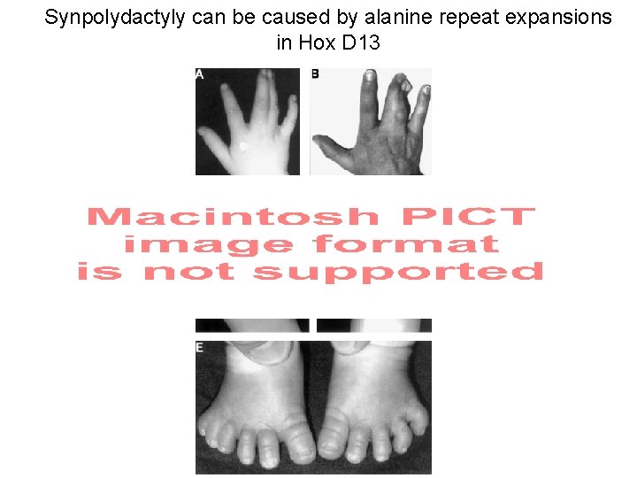 Synpolydactyly can be caused by alanine repeat expansions in Hox D 13 