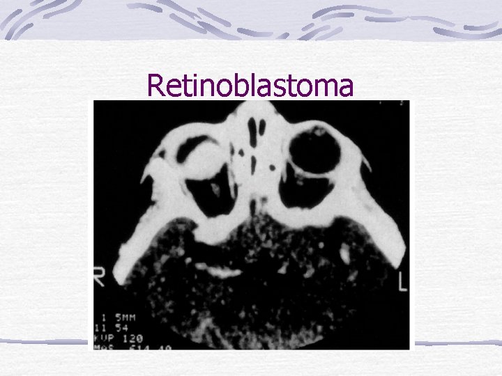 Retinoblastoma 