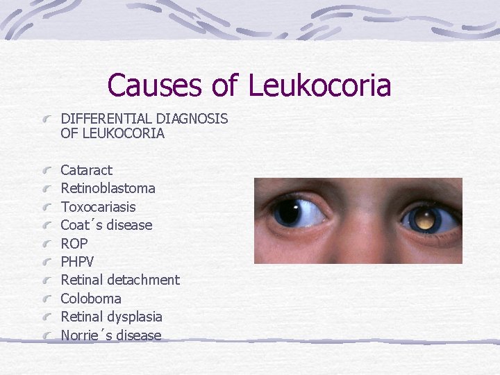 Causes of Leukocoria DIFFERENTIAL DIAGNOSIS OF LEUKOCORIA Cataract Retinoblastoma Toxocariasis Coat´s disease ROP PHPV