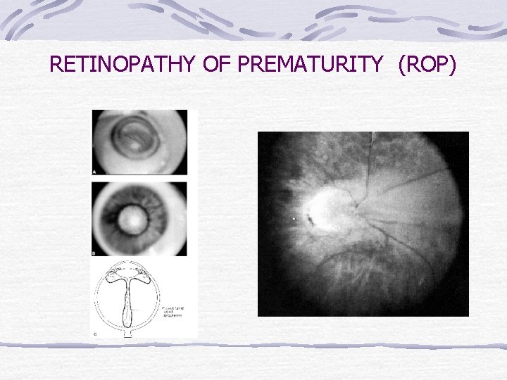 RETINOPATHY OF PREMATURITY (ROP) 