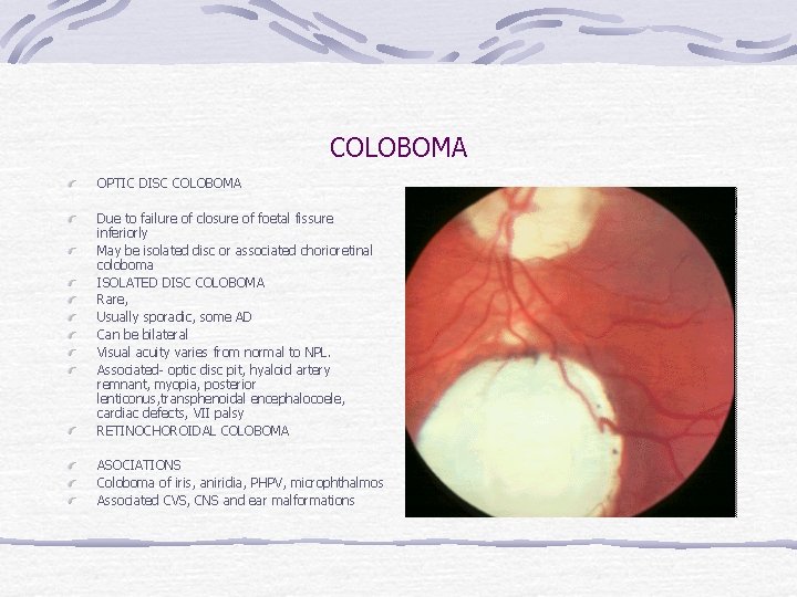 COLOBOMA OPTIC DISC COLOBOMA Due to failure of closure of foetal fissure inferiorly May