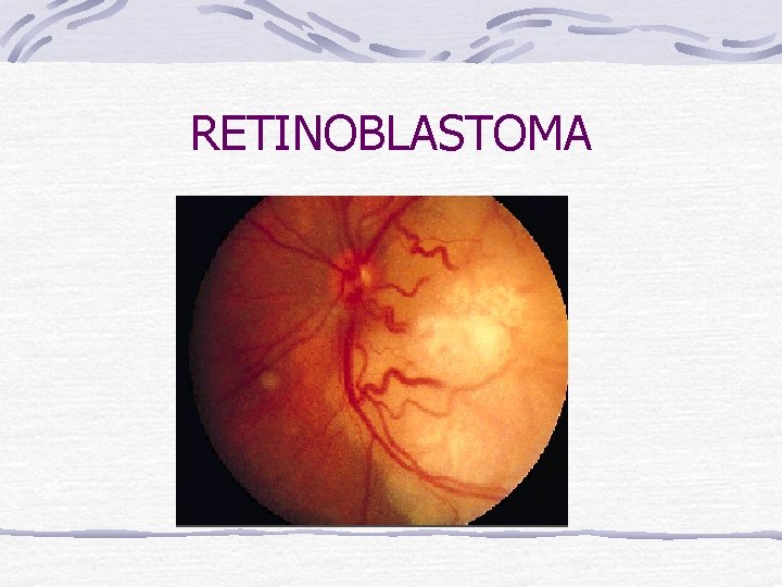 RETINOBLASTOMA 