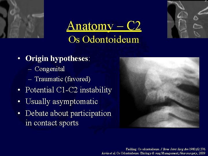 Anatomy – C 2 Os Odontoideum • Origin hypotheses: – Congenital – Traumatic (favored)
