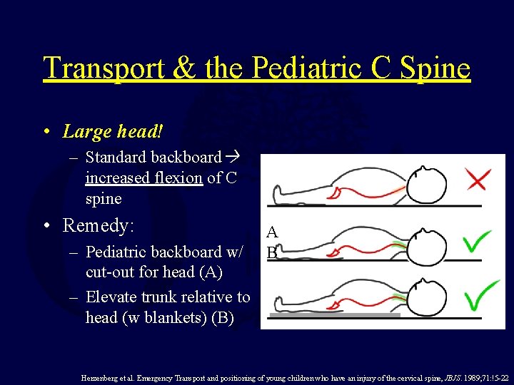 Transport & the Pediatric C Spine • Large head! – Standard backboard increased flexion