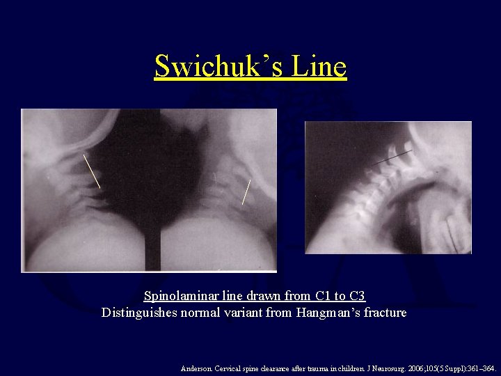 Swichuk’s Line Spinolaminar line drawn from C 1 to C 3 Distinguishes normal variant