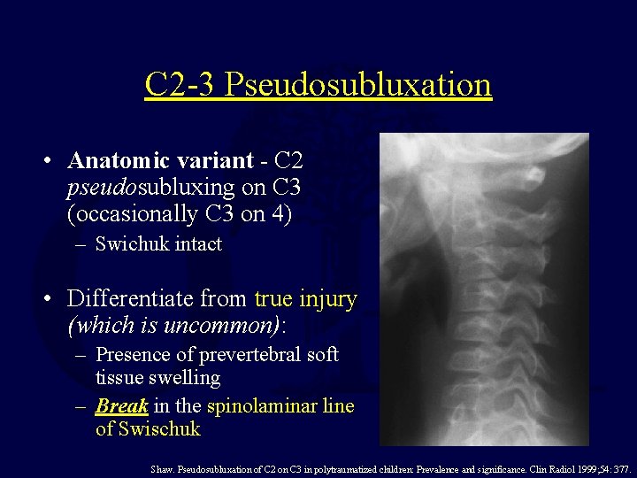 C 2 -3 Pseudosubluxation • Anatomic variant - C 2 pseudosubluxing on C 3