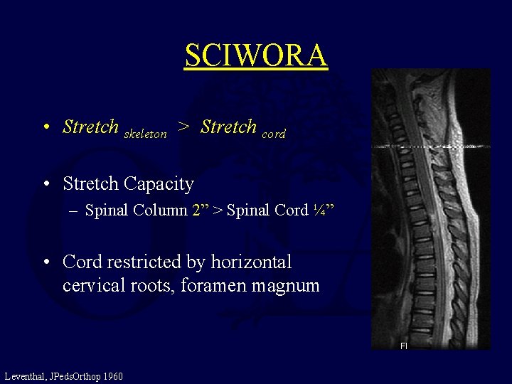 SCIWORA • Stretch skeleton > Stretch cord • Stretch Capacity – Spinal Column 2”