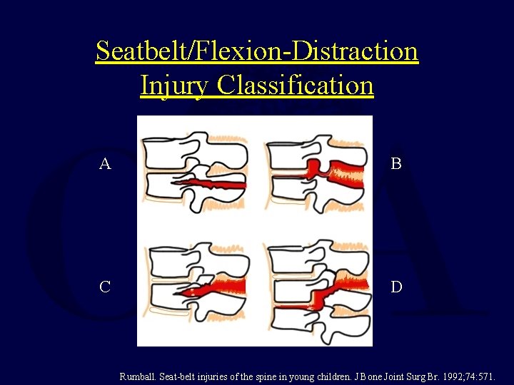 Seatbelt/Flexion-Distraction Injury Classification A B C D Rumball. Seat-belt injuries of the spine in
