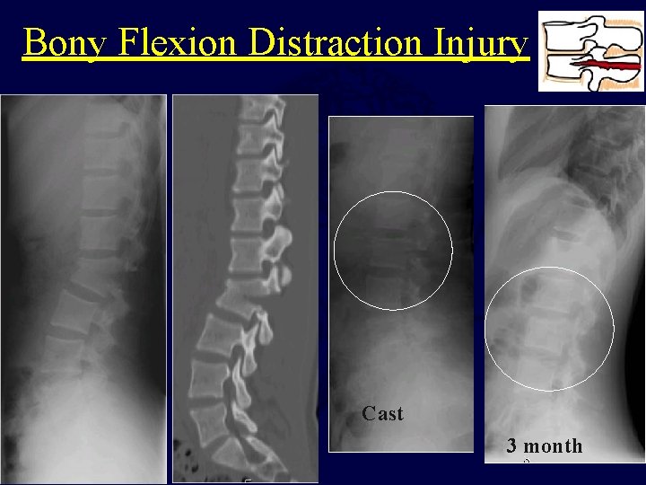Bony Flexion Distraction Injury Cast 3 month 