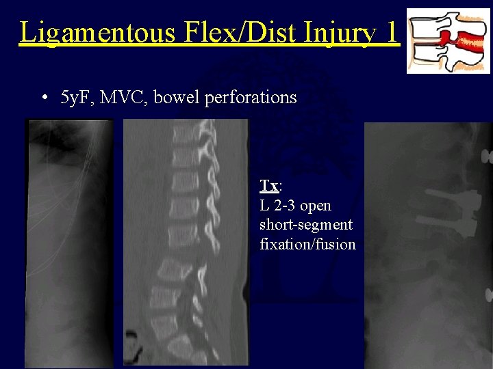 Ligamentous Flex/Dist Injury 1 • 5 y. F, MVC, bowel perforations Tx: L 2