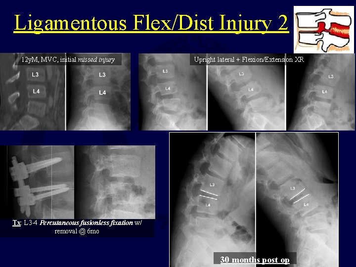Ligamentous Flex/Dist Injury 2 12 y. M, MVC, initial missed injury Upright lateral +