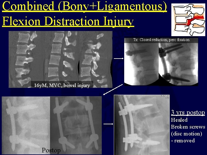 Combined (Bony+Ligamentous) Flexion Distraction Injury Tx: Closed reduction, perc fixation 16 y. M, MVC,