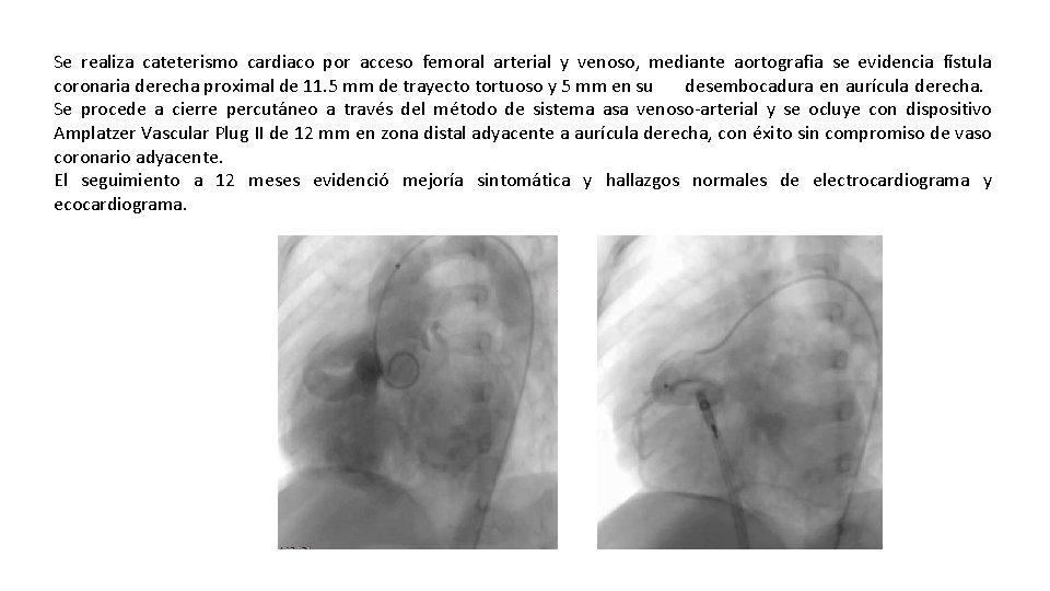 Se realiza cateterismo cardiaco por acceso femoral arterial y venoso, mediante aortografia se evidencia