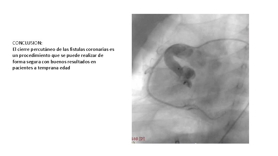 CONCLUSION: El cierre percutáneo de las fistulas coronarias es un procedimiento que se puede