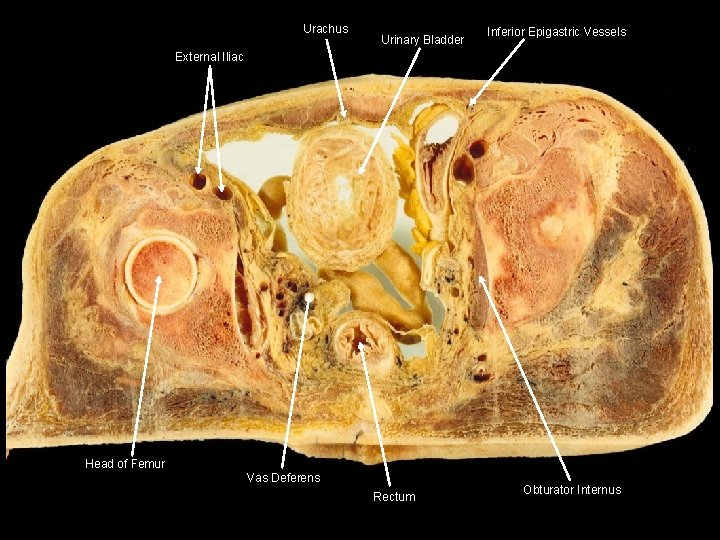 Urachus Urinary Bladder Inferior Epigastric Vessels External Iliac Head of Femur Vas Deferens Rectum