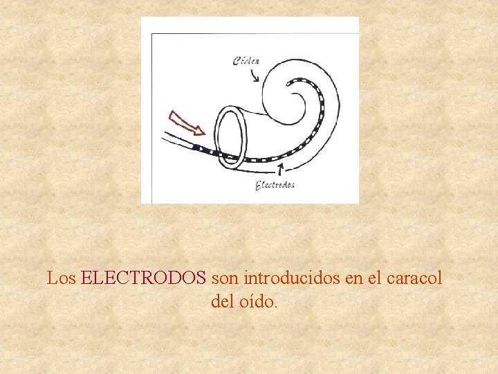 Los ELECTRODOS son introducidos en el caracol del oído. 