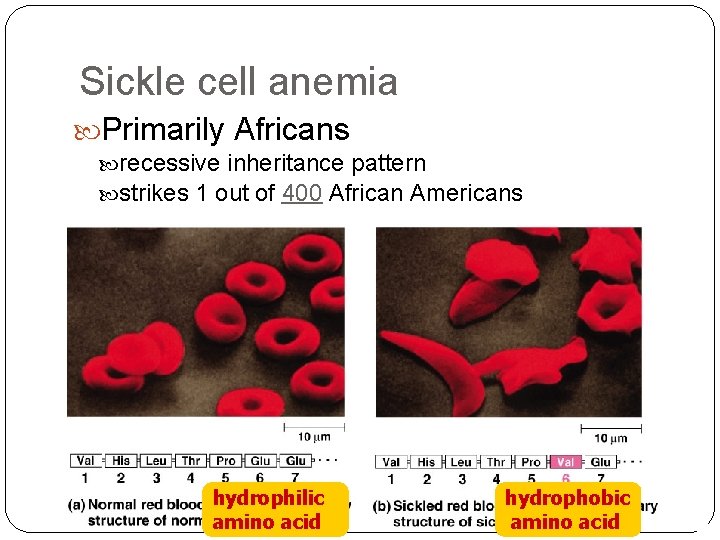 Sickle cell anemia Primarily Africans recessive inheritance pattern strikes 1 out of 400 African