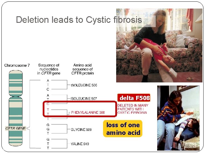 Deletion leads to Cystic fibrosis delta F 508 loss of one amino acid 