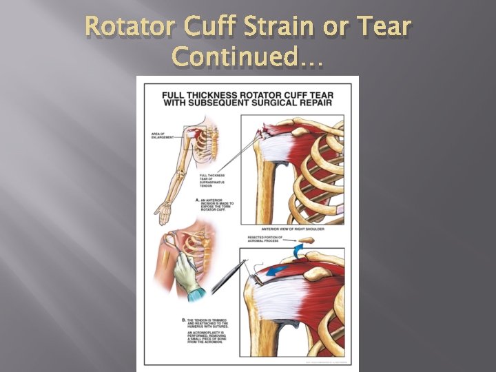 Rotator Cuff Strain or Tear Continued… 