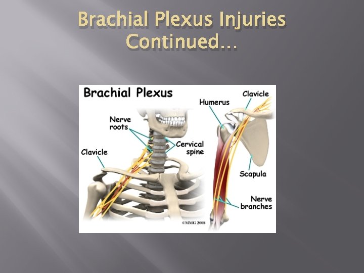 Brachial Plexus Injuries Continued… 