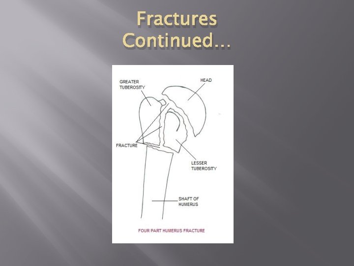 Fractures Continued… 