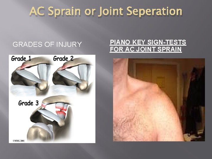 AC Sprain or Joint Seperation GRADES OF INJURY PIANO KEY SIGN-TESTS FOR AC JOINT