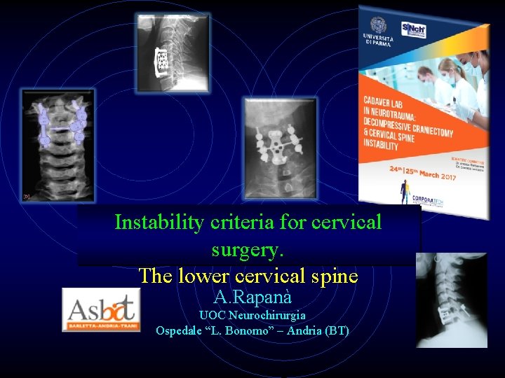 Instability criteria for cervical surgery. The lower cervical spine A. Rapanà UOC Neurochirurgia Ospedale