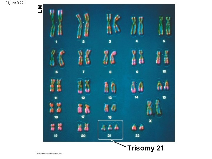 LM Figure 8. 22 a Trisomy 21 