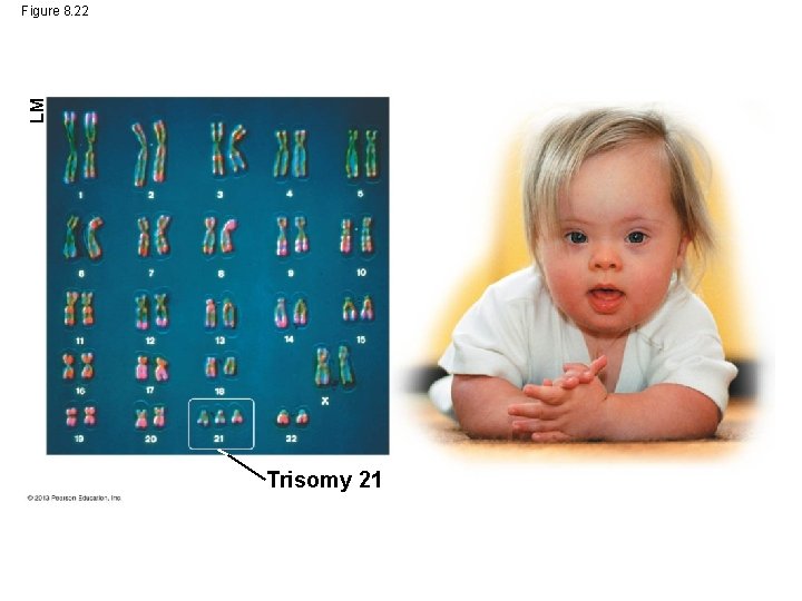 LM Figure 8. 22 Trisomy 21 