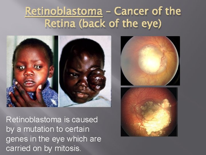 Retinoblastoma – Cancer of the Retina (back of the eye) Retinoblastoma is caused by