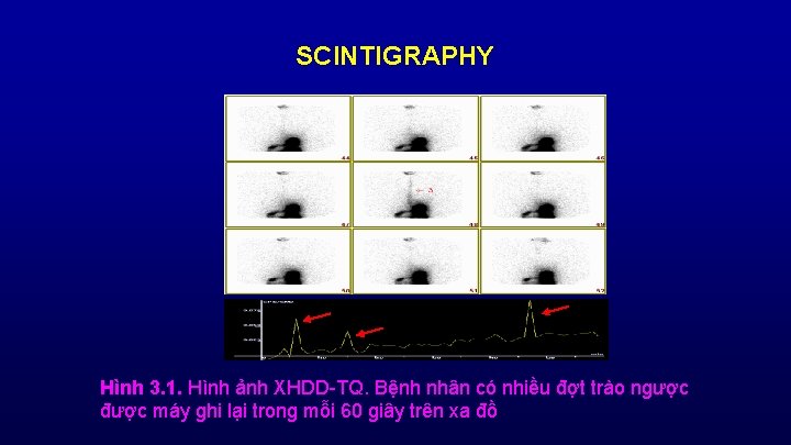 SCINTIGRAPHY Hình 3. 1. Hình ảnh XHDD-TQ. Bệnh nhân có nhiều đợt trào ngược