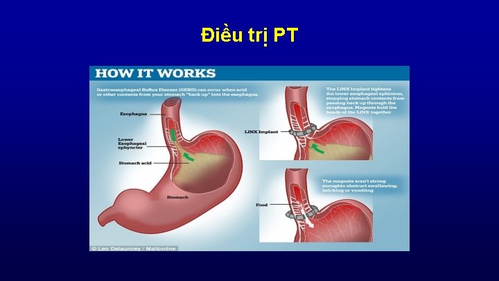 Điều trị PT 