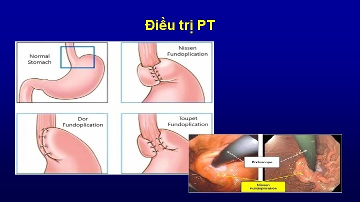 Điều trị PT 