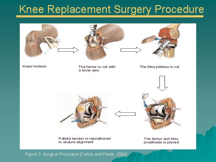 Knee Replacement Surgery Procedure Figure 2: Surgical Procedure [Collins and Pavlik, 2004] 