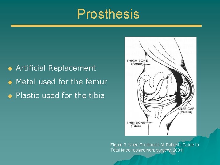 Prosthesis u Artificial Replacement u Metal used for the femur u Plastic used for
