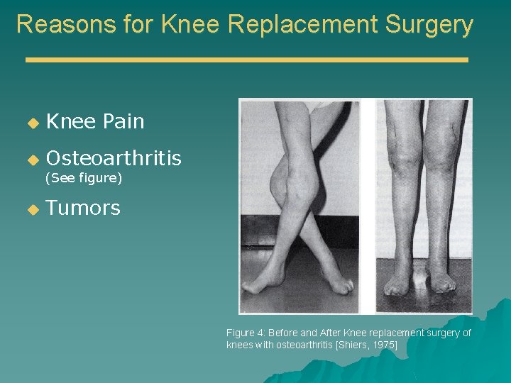 Reasons for Knee Replacement Surgery u Knee Pain u Osteoarthritis (See figure) u Tumors