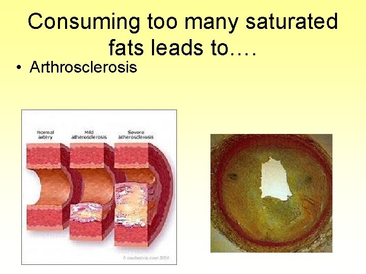 Consuming too many saturated fats leads to…. • Arthrosclerosis 